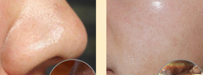 Mascarilla Limpiadora Profunda Antiespinillas - Image 7