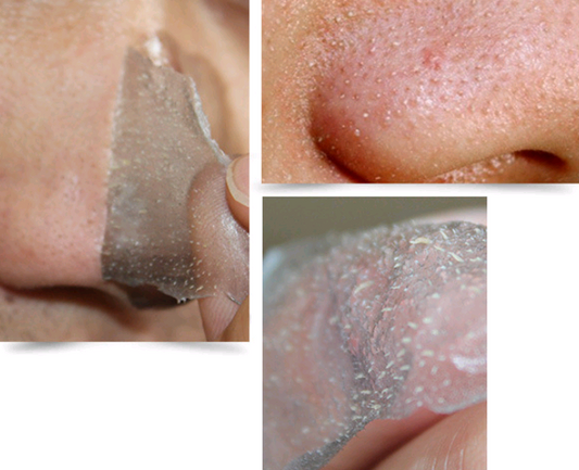 Mascarilla Nasal de Carbón de Bambú - Kit Completo Limpiador de Poros y Eliminador de Espinillas - Image 2