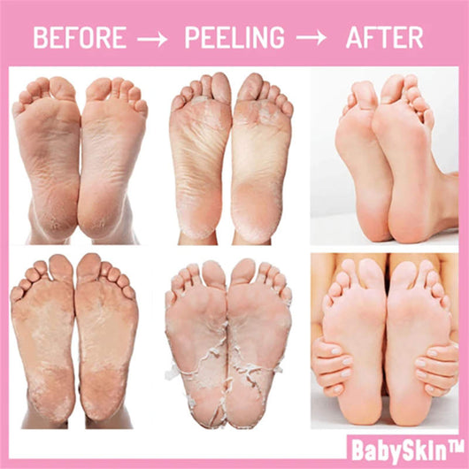 Mascarilla Peeling BabySkin Original - Calidad Premium - Image 7