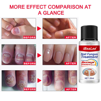 Solución Líquida Bacteriostática Espesante para Onicomicosis - Image 9