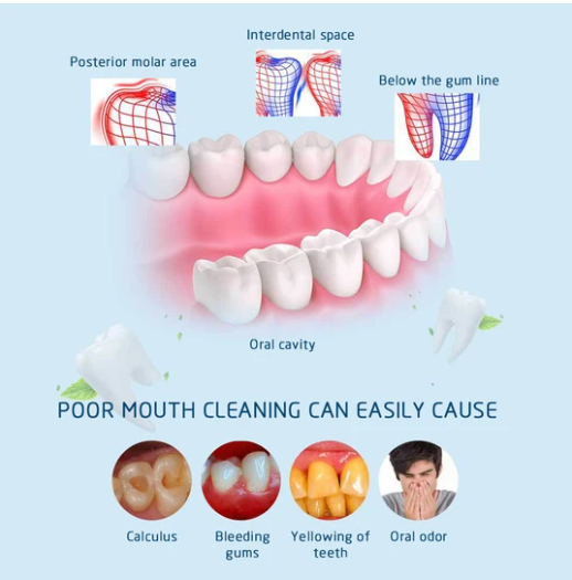Removedor Ultrasónico de Sarro y Placa Dental - Image 11