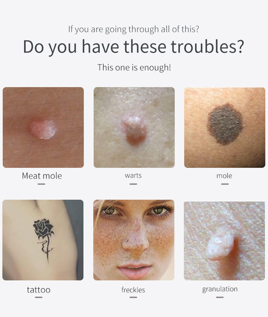 Bolígrafo Láser LCD para Eliminar Pecas y Lunares - Image 13