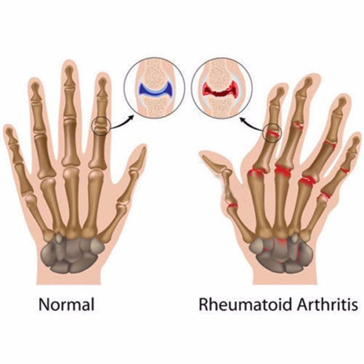Guantes de Compresión con Cobre para Terapia - Image 4