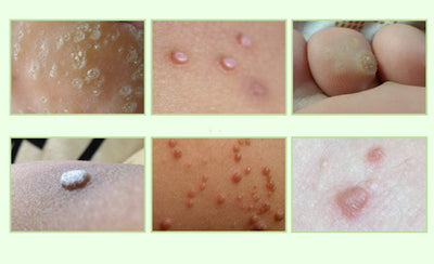 Crema Removedora de Callos y Verrugas Plantares - Parche Médico Profesional - Image 2