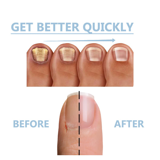 Tratamiento Nutritivo para Uñas de Manos y Pies - Reparación Intensiva y Brillo Natural - Image 4