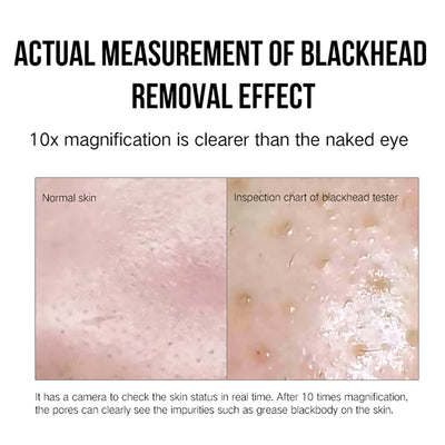 Extractor de Puntos Negros Facial - Image 9