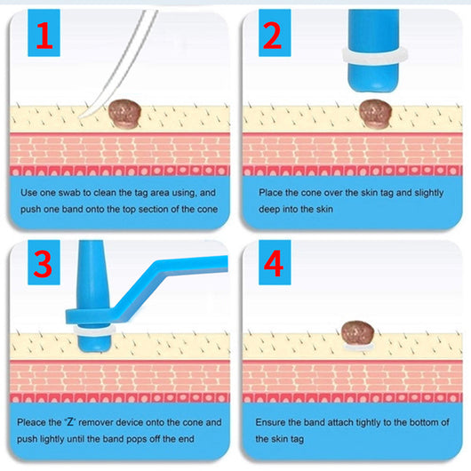 Parches para Uñas Encarnadas - Pack de 10 Tratamientos - Image 3