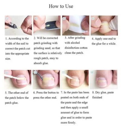 Parche Correctivo Ortodóntico para Uñas Encarnadas con Pinzas de Manicura - Image 3