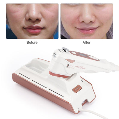 Dispositivo de Lifting Facial Ultrasónico V-Face Anti-envejecimiento - Image 6
