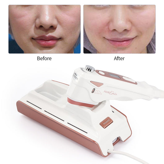 Dispositivo de Lifting Facial Ultrasónico V-Face Anti-envejecimiento - Image 6