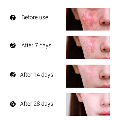 Crema Facial de Árbol de Té BREYLEE - Tratamiento Anti-Acné y Cicatrices - Image 5