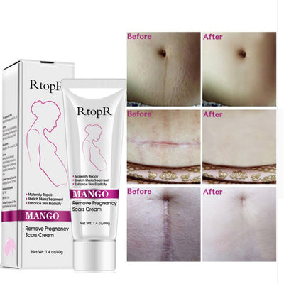 Crema Natural para Estrías de Embarazo - Reparación Intensiva sin Irritación - Image 2