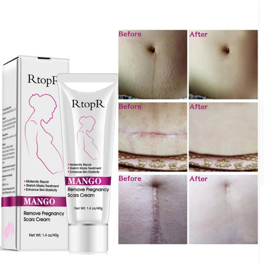 Crema Natural para Estrías de Embarazo - Reparación Intensiva sin Irritación - Image 2