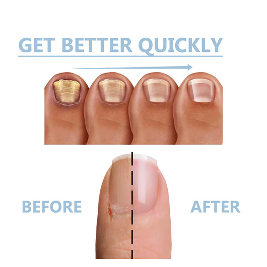 Tratamiento Nutritivo para Uñas de Manos y Pies - Reparación Intensiva y Brillo Natural - Image 13