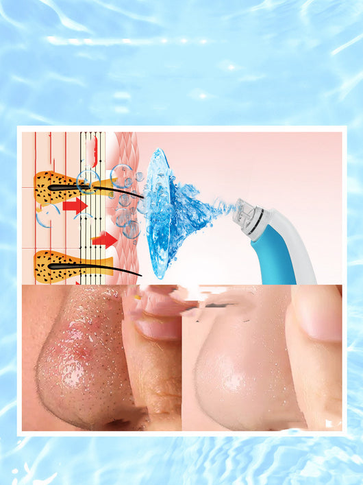 Limpiador de Poros con Burbujas - Instrumento de Belleza Facial - Image 2