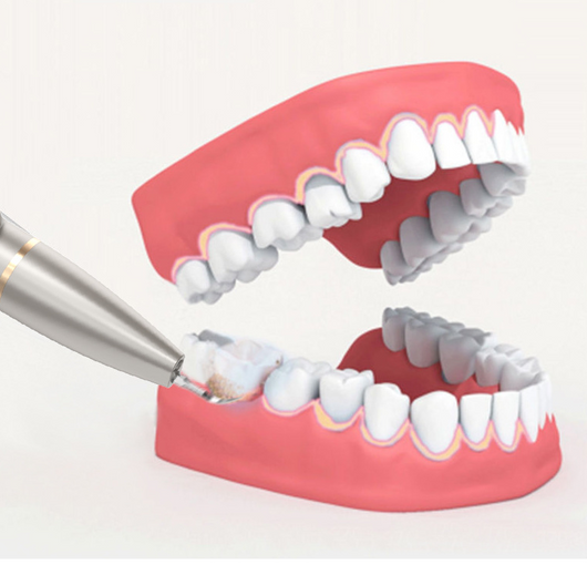 Limpiador Dental Visual de Alta Definición - Image 18