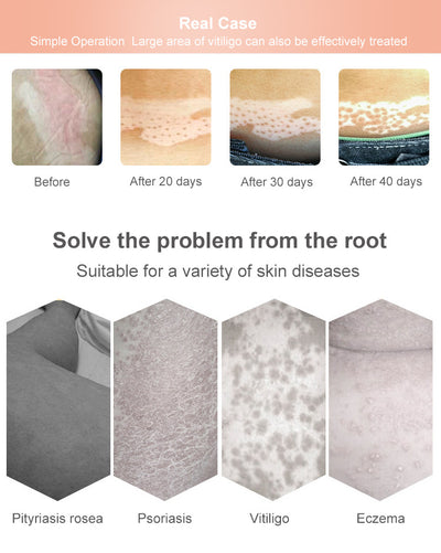 Lámpara UVB Fototerapia Doméstica para Vitíligo y Psoriasis - Image 20