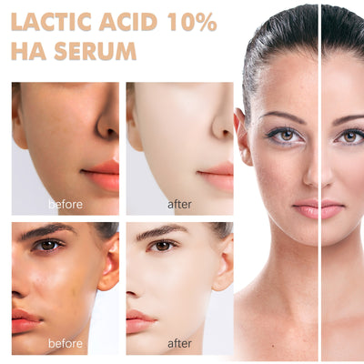 Esencia Facial de Ácido Láctico Anti-acné, Antiarrugas e Hidratante - Image 14