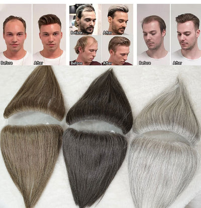 Parches Capilares Invisibles para Hombre - Solución Instantánea de Densidad - Image 13