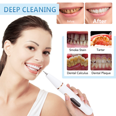 Removedor Ultrasónico de Sarro Dental Eléctrico Profesional - Image 3