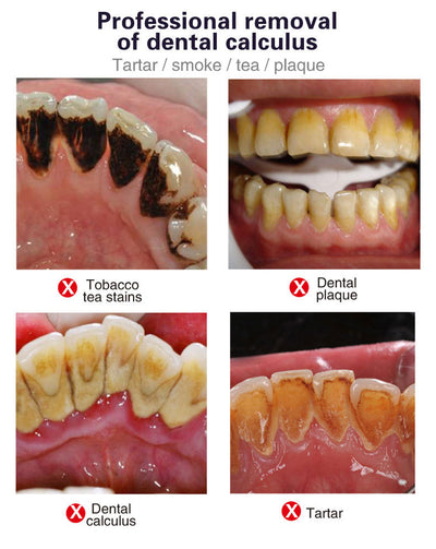 Limpiador Ultrasónico Portátil para Dientes - Raspador Eléctrico Profesional - Image 14