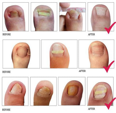 Parche Correctivo Ortodóntico para Uñas Encarnadas con Pinzas de Manicura - Image 9