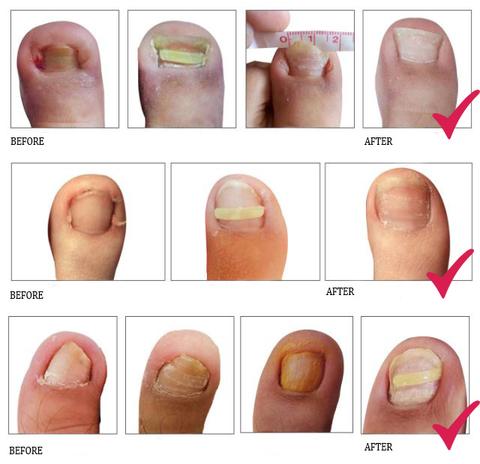 Parche Correctivo Ortodóntico para Uñas Encarnadas con Pinzas de Manicura - Image 9