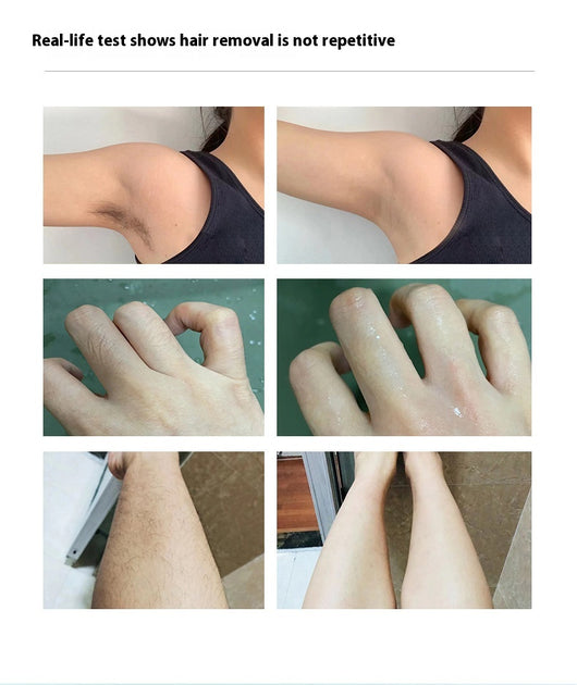Depilador por Congelación - Eliminación Rápida y Permanente - Image 16