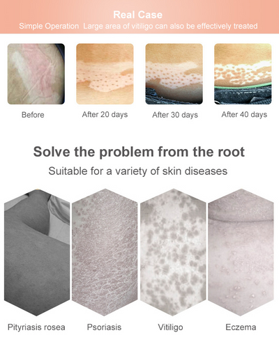 Lámpara UVB Fototerapia Doméstica para Vitíligo y Psoriasis - Image 19