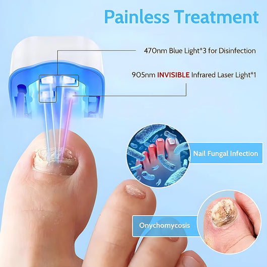 Dispositivo Láser LED Recargable para Eliminar Hongos en Uñas - Image 7