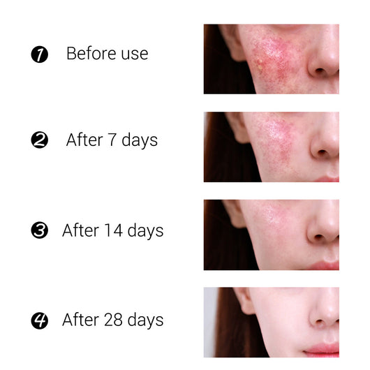 Crema Facial de Árbol de Té BREYLEE - Tratamiento Anti-Acné y Cicatrices - Image 11