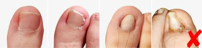 Parche Correctivo Ortodóntico para Uñas Encarnadas con Pinzas de Manicura - Image 8