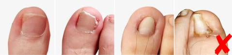 Parche Correctivo Ortodóntico para Uñas Encarnadas con Pinzas de Manicura - Image 8